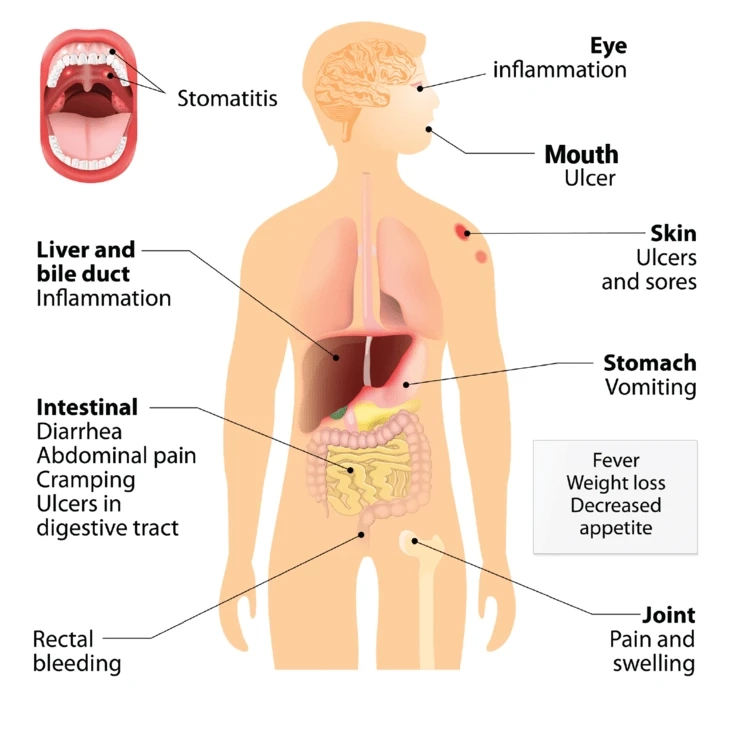 What is Crohn's Disease: Types, Symptoms, and Causes