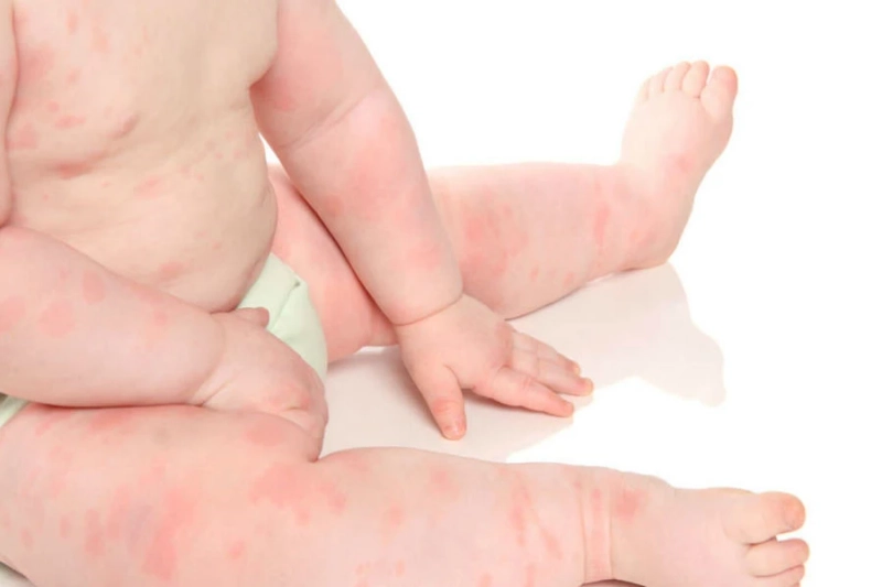 الحساسية لدى الأطفال: دليل الوالدين لكشف العلامات الخفية وتأمين راحة الصغار