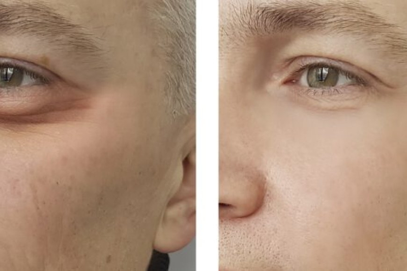 Rejuvenating Elegance Understanding Tear Trough Filler Treatment