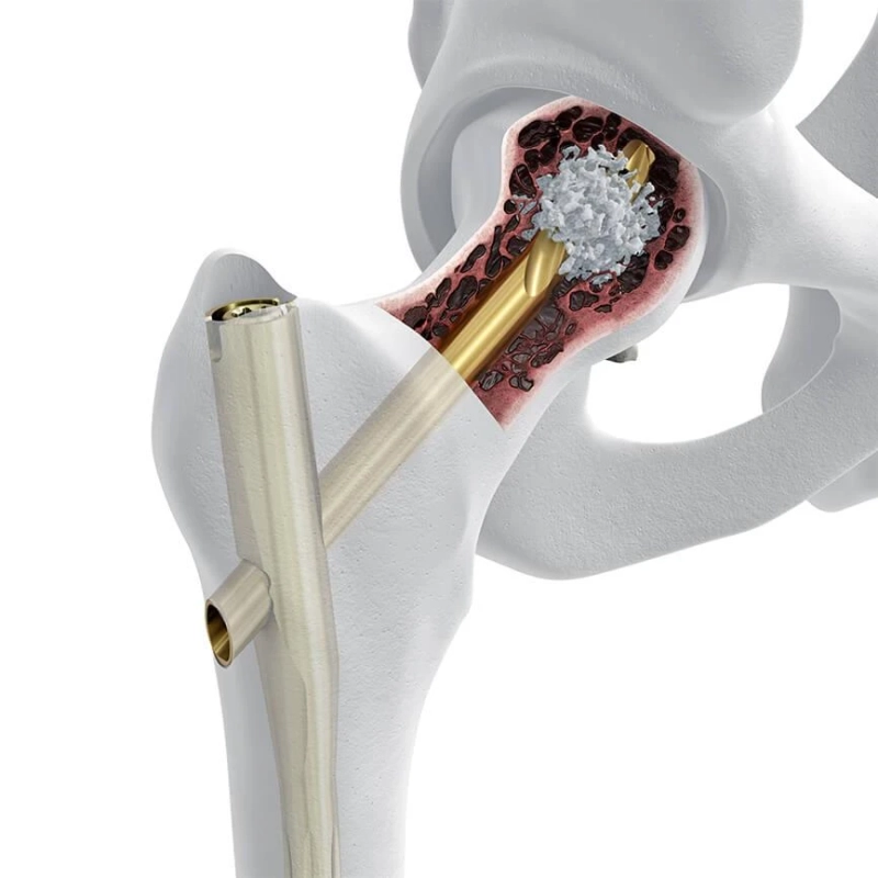 Demand For Orthopedic Trauma Devices in Germany to Increase Due To Rise in Diagnosis and Resultant C