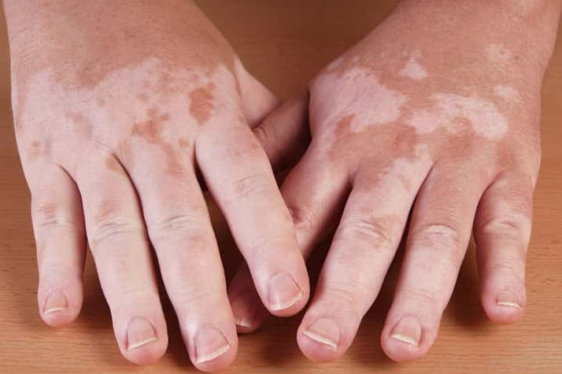 Dermatologist Recommended Tips To Prevent Vitiligo From Worsening