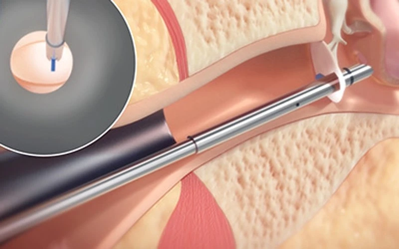 Tympanostomy Products Are Used During Surgery and To Treat Otitis Media With Effusion (OME