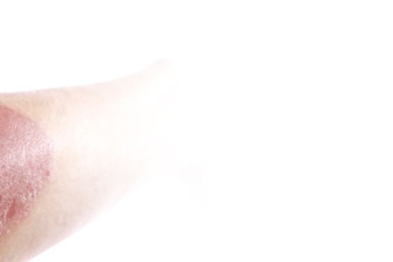 How is Psoriasis Treated?