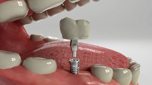 Enhance Comfort and Appearance with Sedation and Implant Dentistry