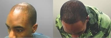 Does light therapy work for hair loss?