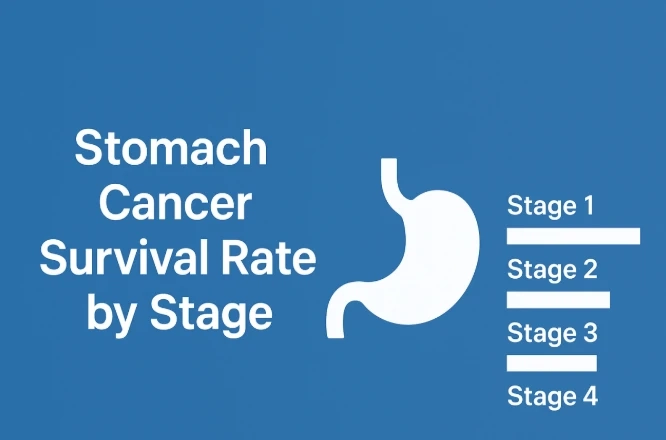 Stomach Cancer Survival Rate by Stage