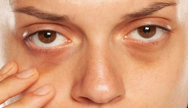 Say Farewell to Dark Circles: Dubai's Best Treatments