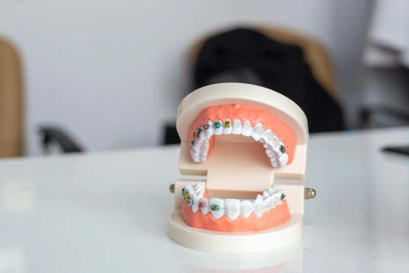 Achieving a Perfect Smile: Exploring the Benefits and Cost of Invisible Braces in Karachi