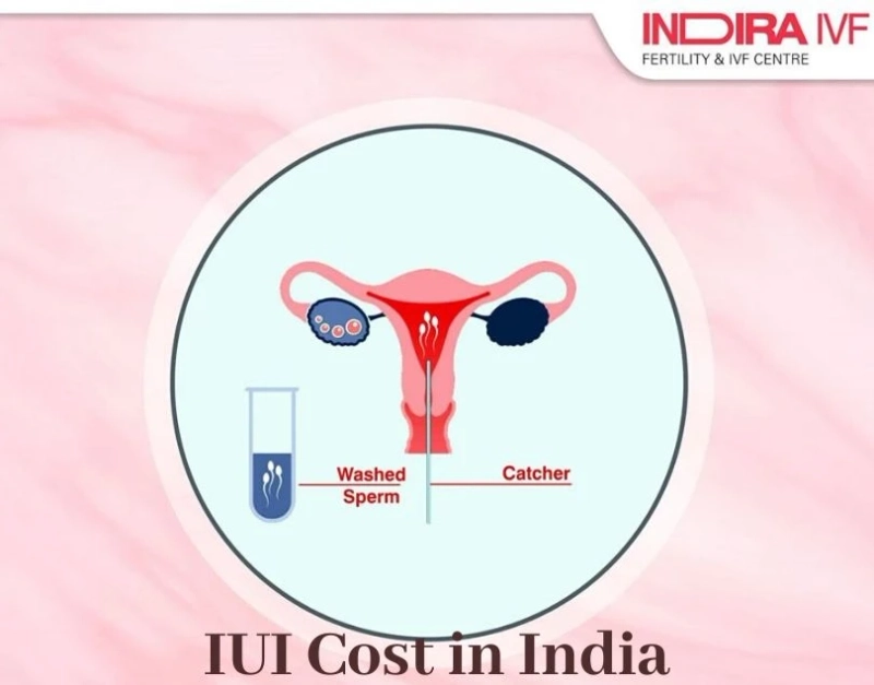 An A to Z Guide: IUI Treatment cost in India – Indira IVF