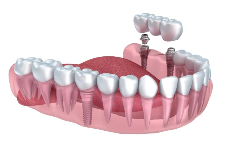 Cosmetic Dental Implants Are Anchored to the Jaw Just Like Natural Teeth