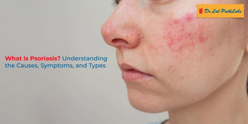 What is Psoriasis? Understanding the Causes, Symptoms, and Types 