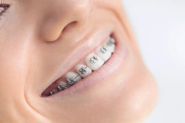 Do You Need Braces? Key Reasons to Consider Orthodontic Care