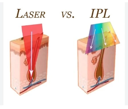 Diode Laser vs IPL: Key Differences Clients Should Know