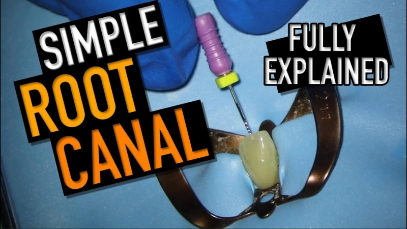 Root Canal & Infection: A Simple Guide For Patients