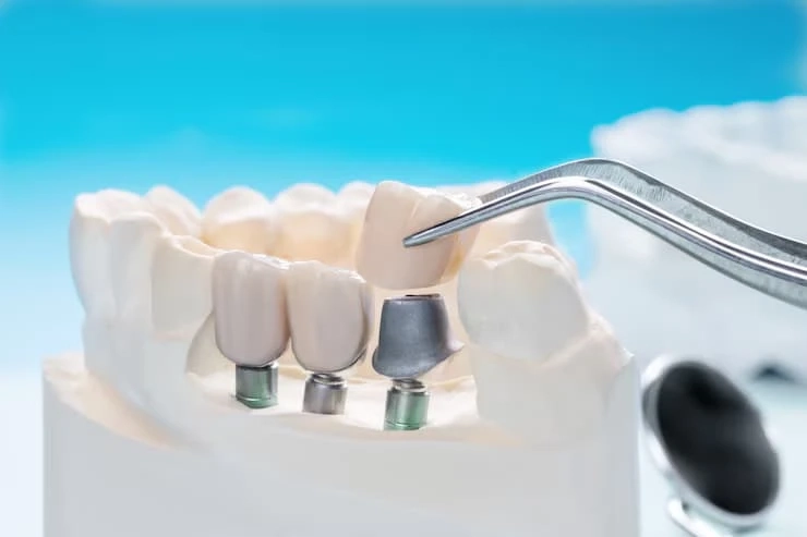Discover Top Teeth Implants Birmingham Clinics for Natural, Long-Lasting Smiles