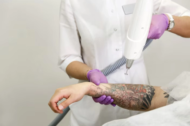 Tattoo Removal for Sensitive Skin: Tips and Precautions