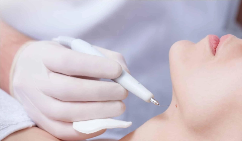 Bid Farewell to Warts: Dubai's Innovative Removal Techniques