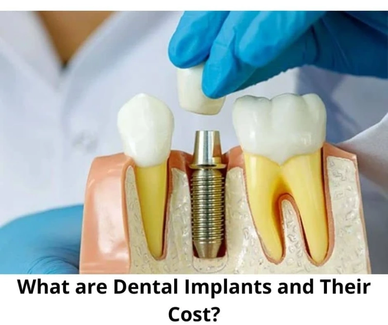 What are Dental Implants and Their Cost?