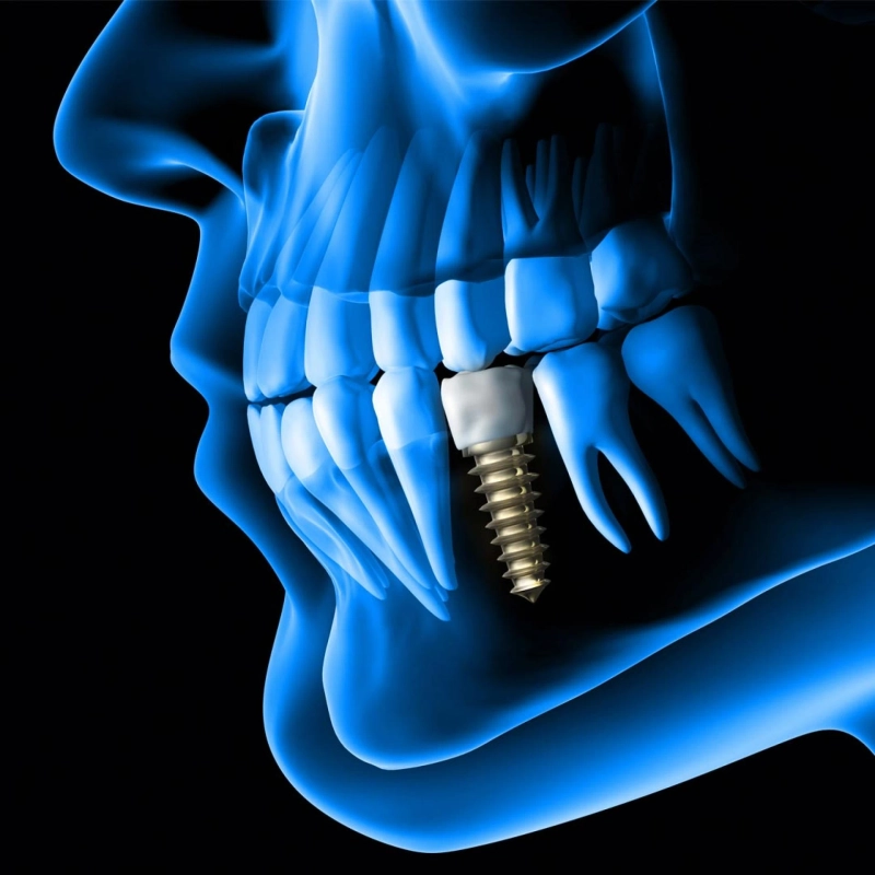 Unveiling the World of Same Day Dental Implants in Dubai