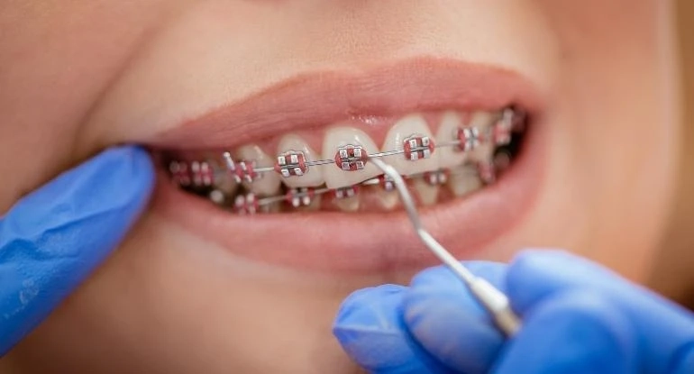How Braces Can Improve Your Smile