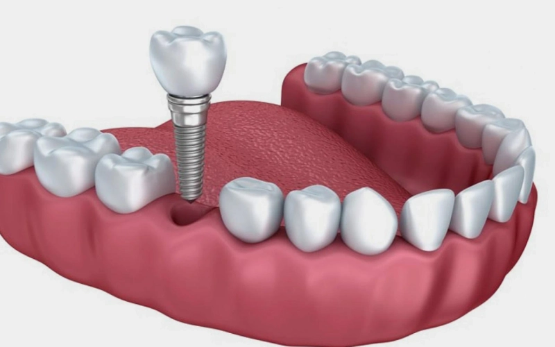 Root Canal Treatment in Panchkula: What to Expect