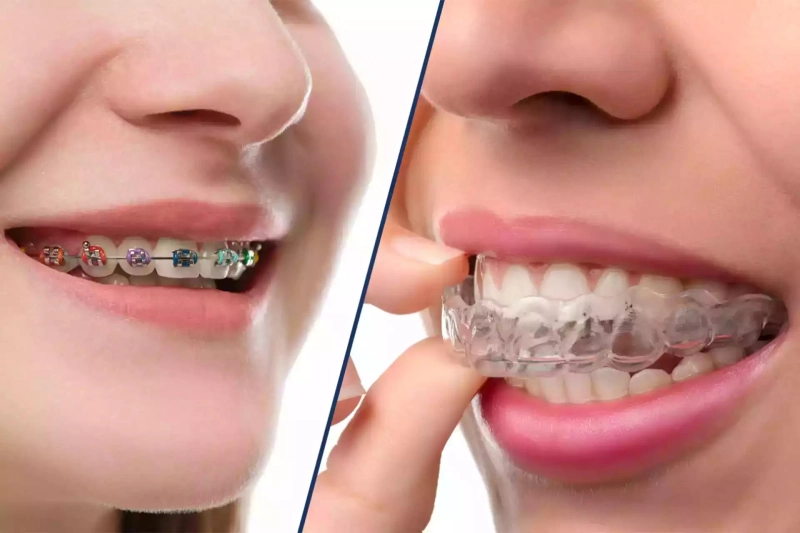 Orthodontic Treatment in Dubai: Expert Orthodontic Care by Leading Orthodontists in the UAE