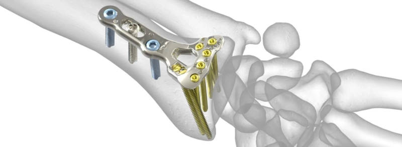Global Radial Head Resection Implants Market Analysis
