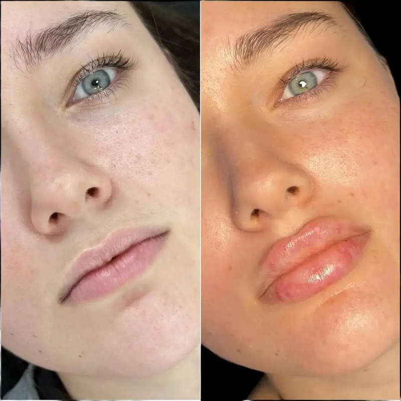 Fillers Treatments in Dubai: A Non-Surgical Solution