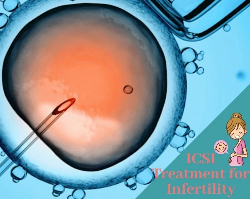 A start to end guide of ICSI Process: In Vitro fertilization with ICSI – Indira IVF
