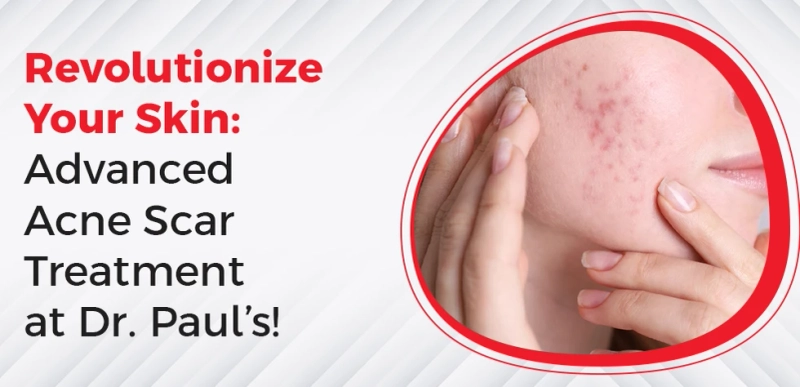 Are Acne Scars Affecting Your Confidence?