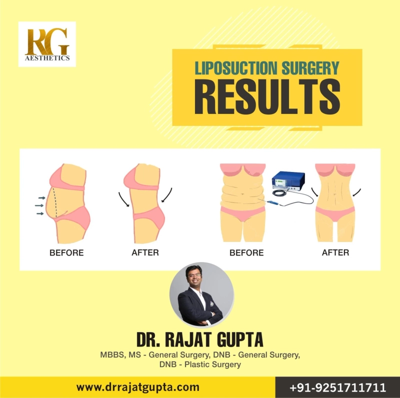 best liposuction surgeon in delhi