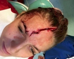 Goleira do Liverpool se compara a Harry Potter depois de corte na testa