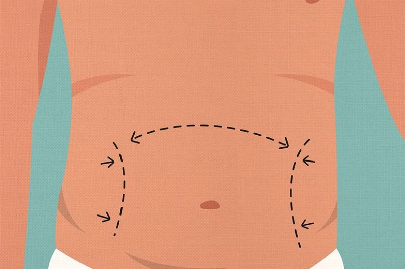 How to Prepare for a Tummy Tuck: Tips for Optimal Results and Recovery