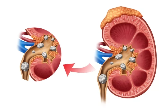 What is the fastest way to get rid of kidney stones?