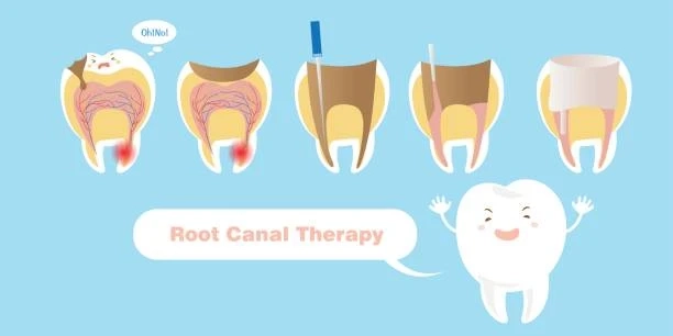 How Root Canal Therapy Saves Your Natural Teeth