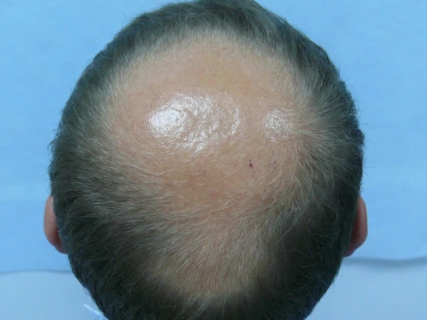 Understanding Androgenetic Alopecia Treatment: Causes and Treatment Options