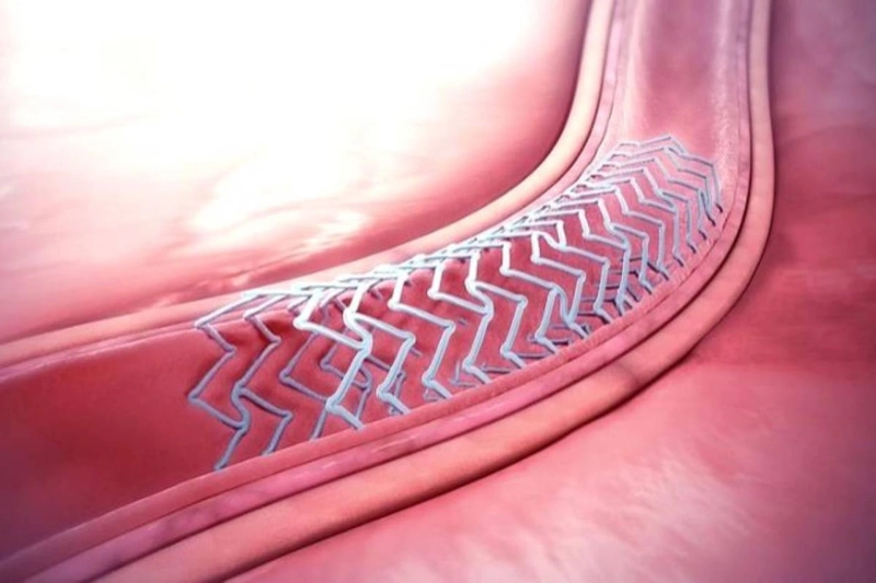 A Bioabsorbable Stents Dissolve Within The Body Over Time, They Treat Coronary Artery Disease