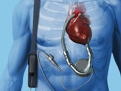 Assisted pumping of blood from the lower chambers of the heart by Ventricular Assist Devices
