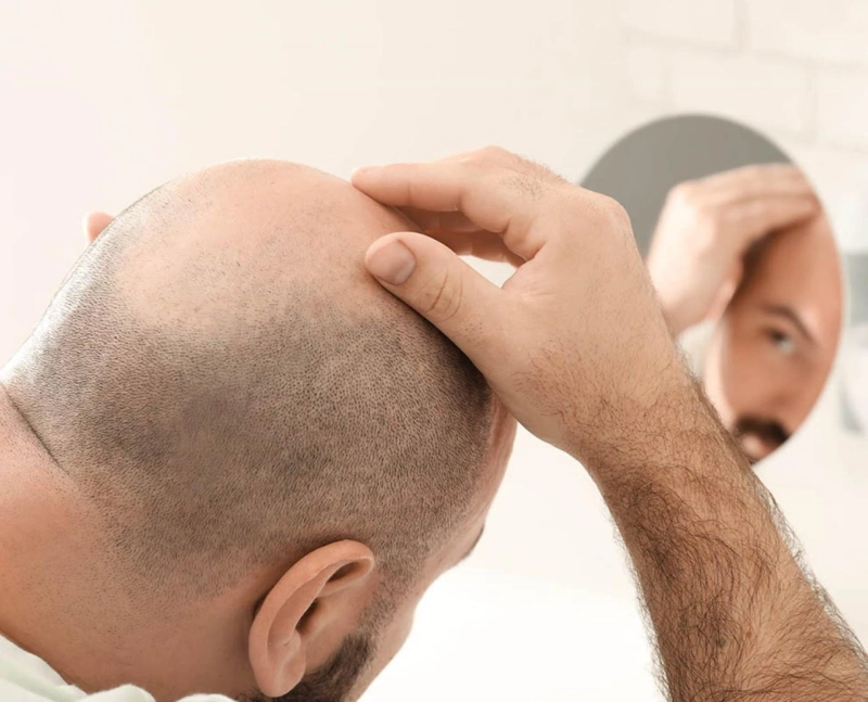 How can I Find Reputable Hair Transplant Doctors in Jaipur