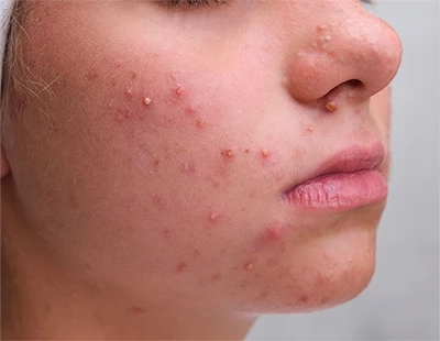 Clear Skin Journey: A Step-by-Step Guide to Effective Acne Treatment