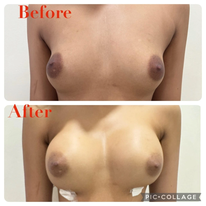 Body Contouring Revolution: Liposuction and Fat Removal Procedures