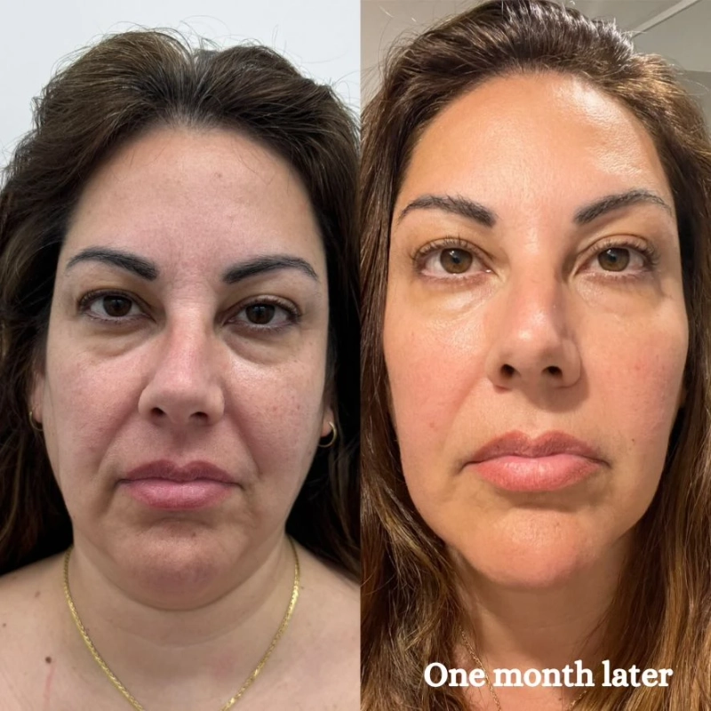  Is HIFU safe for all skin types and ages? What does the science say