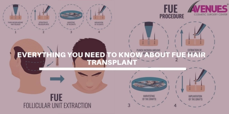 Everythingyou need to know about Follicular Unit Extraction Hair Transplant