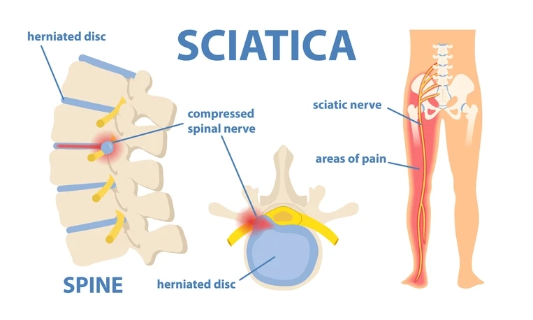 In Sciatica, The Sciatic Nerve Or Sciatic Nerve Root Is Pathologic, Resulting In Debilitating Pain