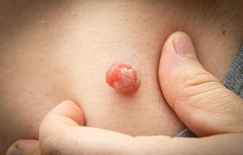 Types of Growths Around the Anus and How to Identify Them