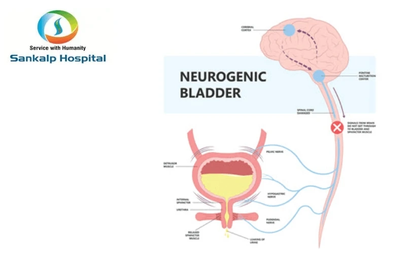 What exactly is a Neurogenic Bladder?