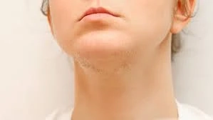 How Important Is Eflornithine Cream To Remove Facial Hair