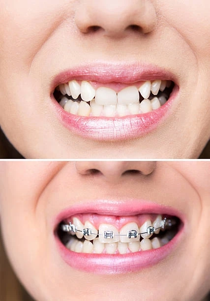 Dental Braces Cost In Dubai: Choosing the Right Type for Your Needs