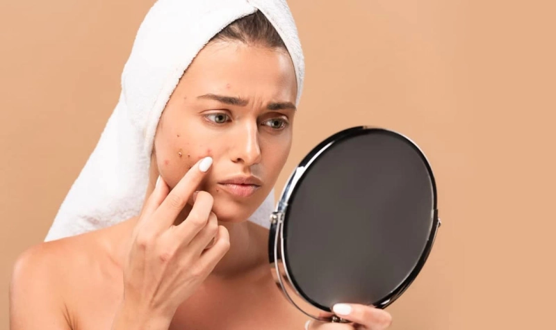 Acne Treatment in Ludhiana