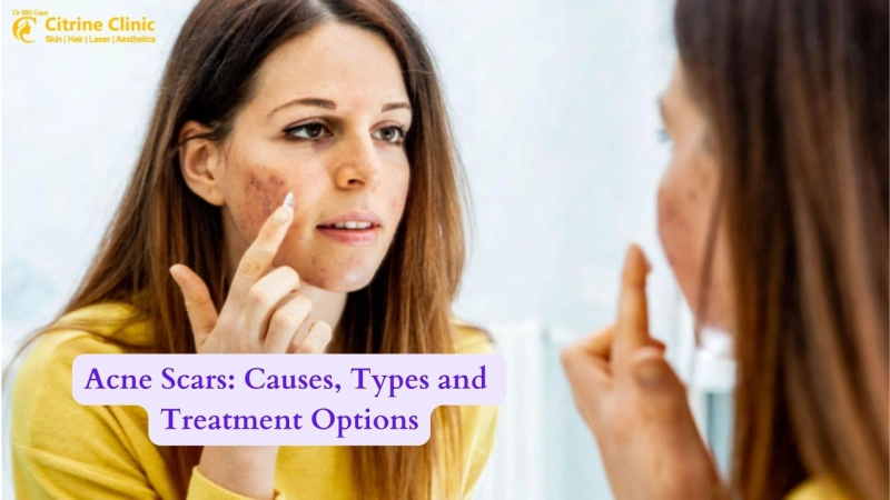 Acne Scars: Causes, Types and Treatment Options